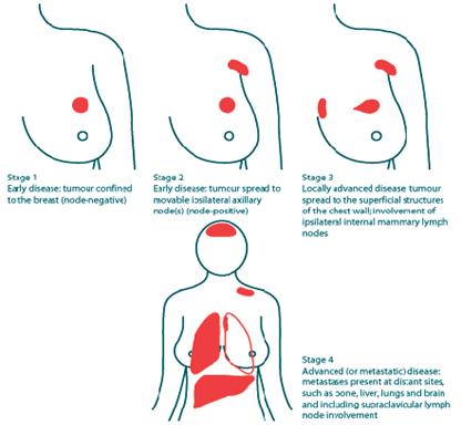 Breast-Cancer-Stages2